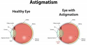 Astigmatism and its correction lenses | Blog - Buy Contact Lenses in pakistan @ lenspk.com