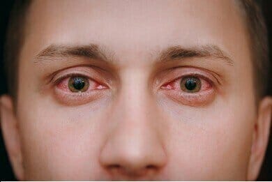 What's the difference between pink eye and allergies